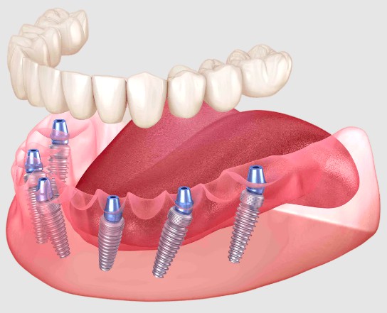 Имплантация зубов по системе All-on-6 Ddf8759657